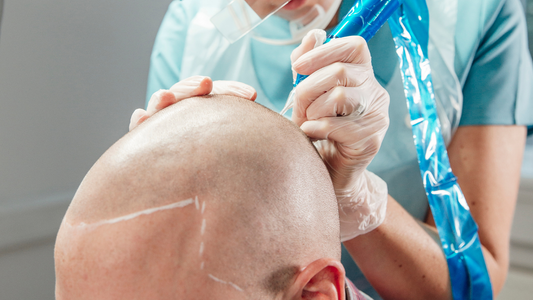 Why PMU Artists Are Adding SMP (Scalp Micropigmentation) to Their Services