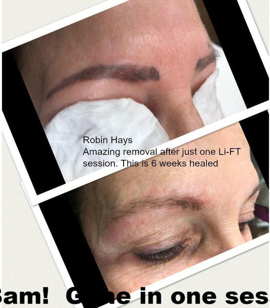 Healed brow pigment removal after one Li-FT session, performed by Robin Hays using saline technique