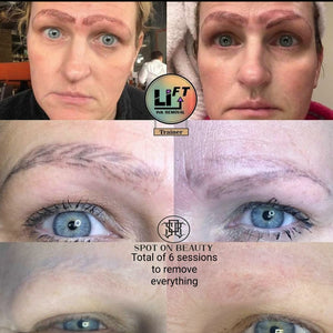 Li-FT saline PMU removal solutions supporting safe pigment correction and non-laser removal methods