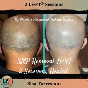 Li-FT saline removal system for correcting unwanted permanent makeup and cosmetic tattoo work SMP Removal