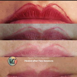 Permanent makeup removal products by Li-FT designed for controlled saline correction procedures