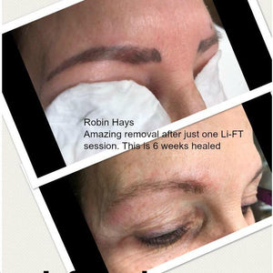 Healed brow pigment removal after one Li-FT session, performed by Robin Hays using saline technique