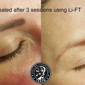Eyebrow tattoo removal healed results after three Li-FT saline removal sessions by Girlz Ink's very own Teryn Darling.