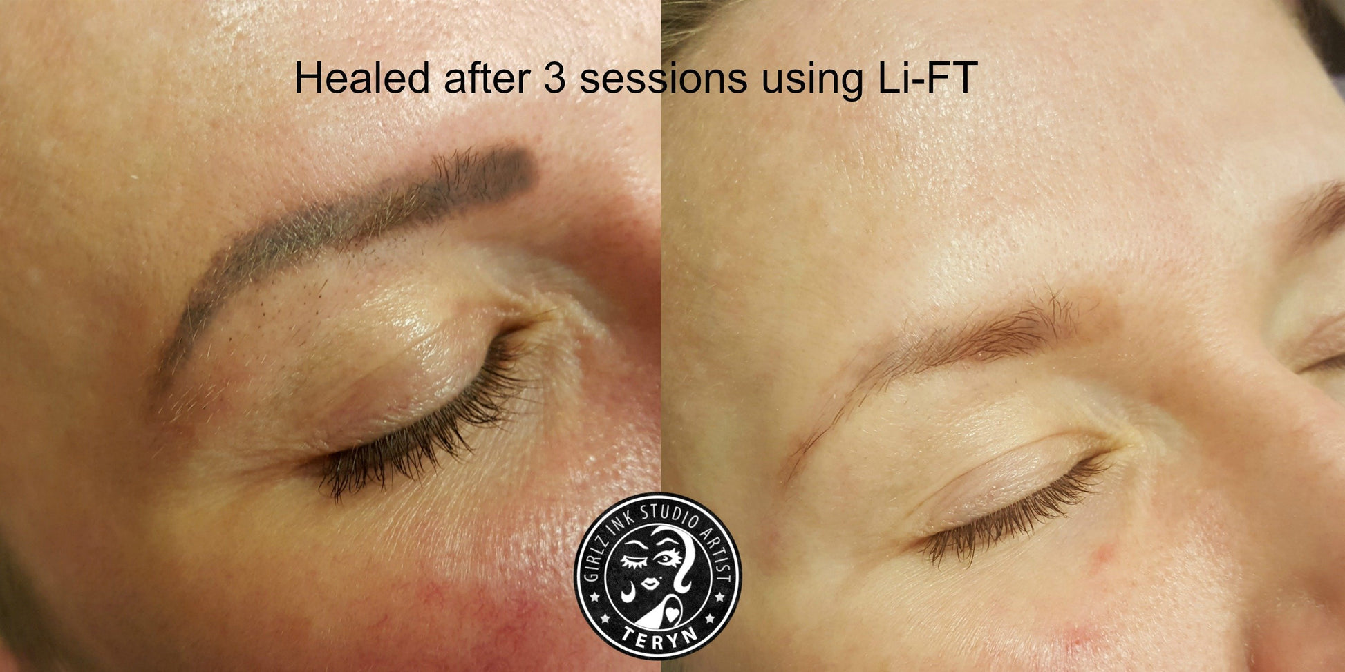 Eyebrow tattoo removal healed results after three Li-FT saline removal sessions by Girlz Ink's very own Teryn Darling.