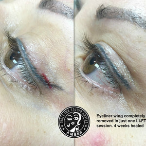 Eyeliner wing removal results after one Li-FT saline removal session by Amber, healed at four weeks.