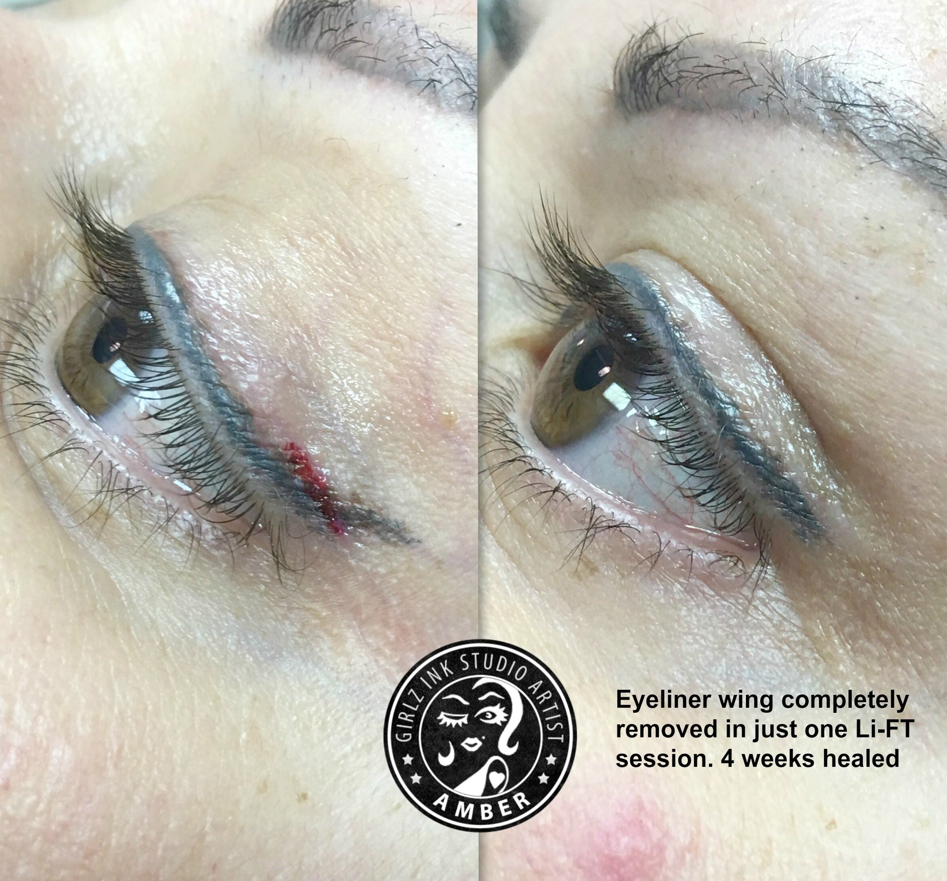 Eyeliner wing removal results after one Li-FT saline removal session by Amber, healed at four weeks.
