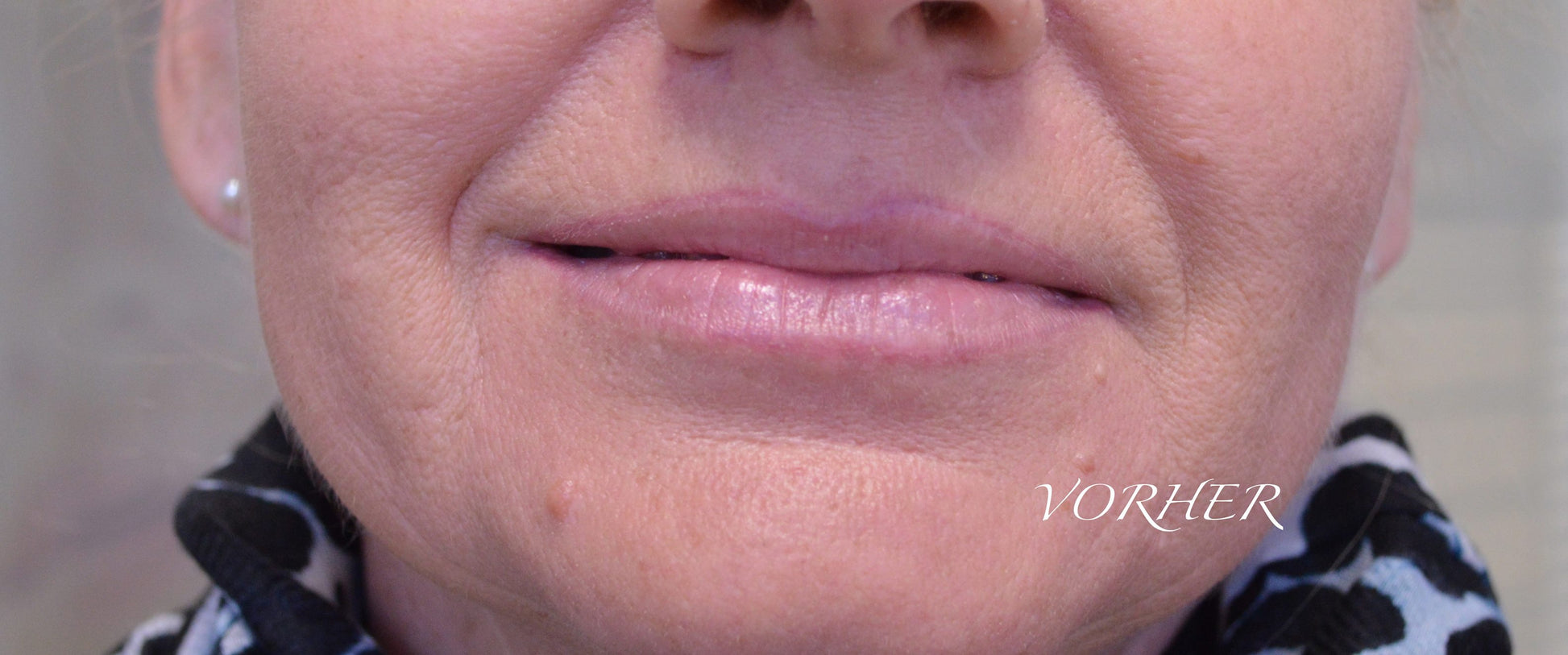 Healed lip neutralization result using Aqua Pink and 3 drops of Neon Orange Mod by Caroline De Jonge.