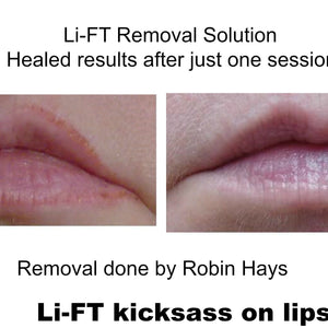 Li-FT saline removal results showing lightened permanent makeup on lips after one session by Robin Hays.