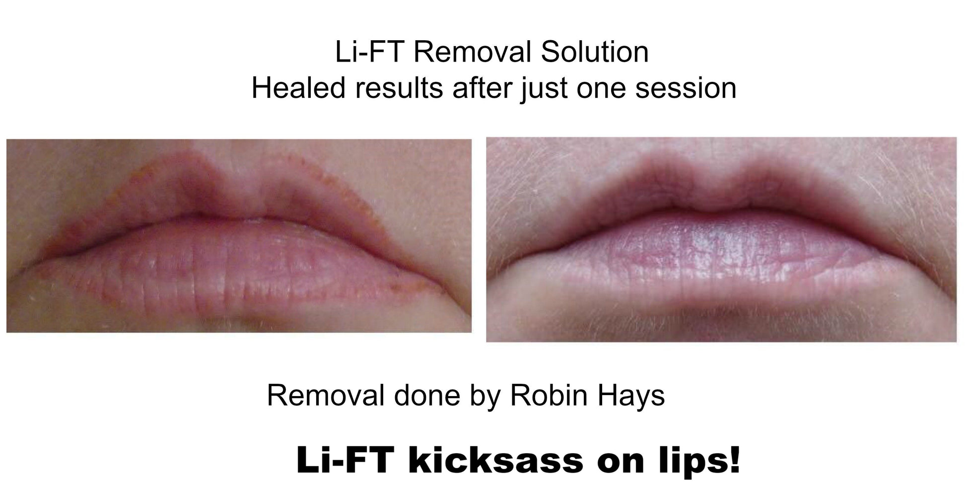 Li-FT saline removal results showing lightened permanent makeup on lips after one session by Robin Hays.