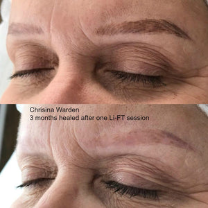 3-month healed results after one Li-FT saline removal session on PMU brows by Christina Warden.