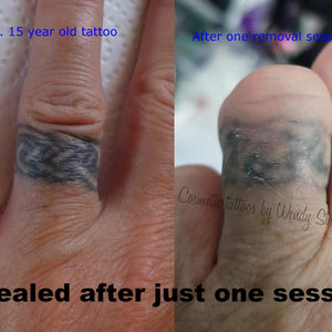 Healed tattoo ring removal after one Li-FT pigment lightening session using a machine and 5 liner by Wendy Strachan.