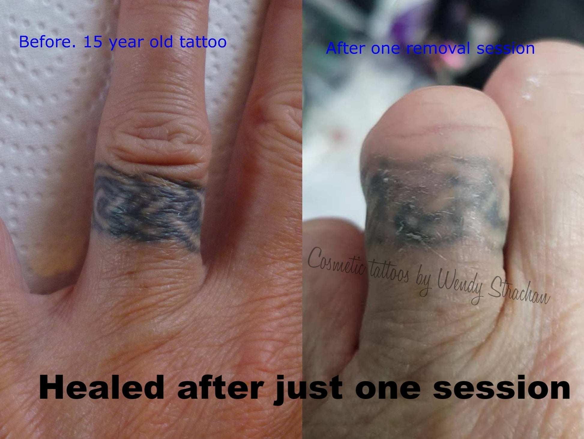 Healed tattoo ring removal after one Li-FT pigment lightening session using a machine and 5 liner by Wendy Strachan.